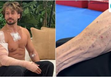 Tiger Shroff's Team Shares Video of Burn Marks After Attack
