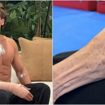 Tiger Shroff's Team Shares Video of Burn Marks After Attack