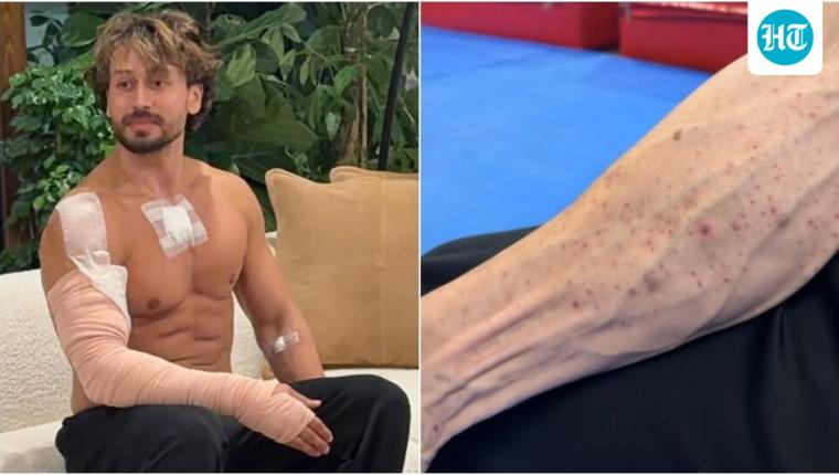 Tiger Shroff's Team Shares Video of Burn Marks After Attack