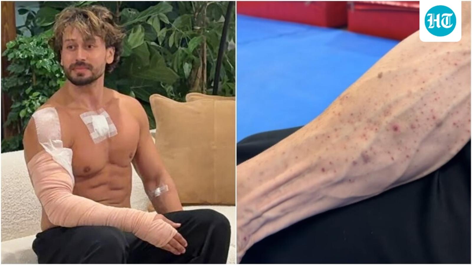 Tiger Shroff's Team Shares Video of Burn Marks After Attack